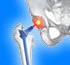Orthopedic knee prostheses