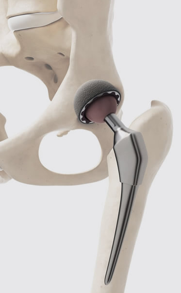 Orthopedic prostheses in guadalajara