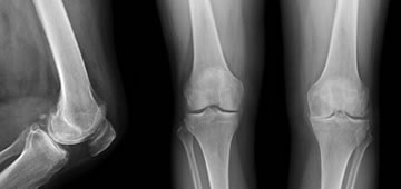 Orthopedics and knee prostheses in Guadalajara