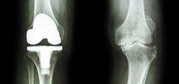 Ortopedia y prótesis de rodilla en Guadalajara